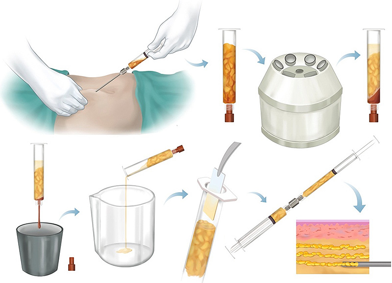 روند انجام و فرایند تزریق چربی به بیکینی یا واژن و لب های تناسلی