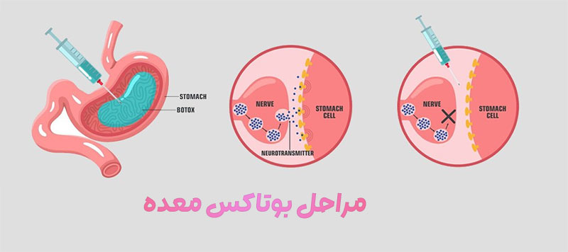 مراحل بوتاکس